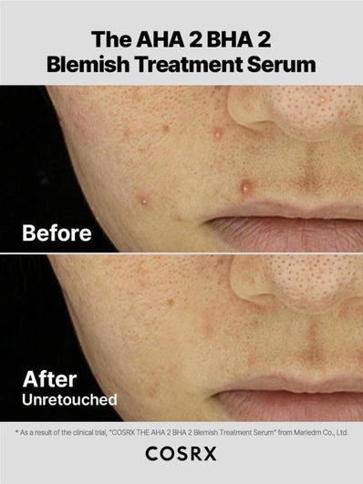 Cosrx - The AHA 2 BHA 2 Blemish Treatment Serum