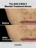 Cosrx - The AHA 2 BHA 2 Blemish Treatment Serum